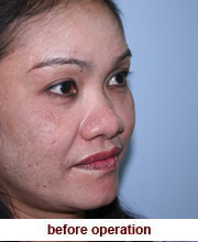 plastic_surgery_augmentation_rhinoplasty